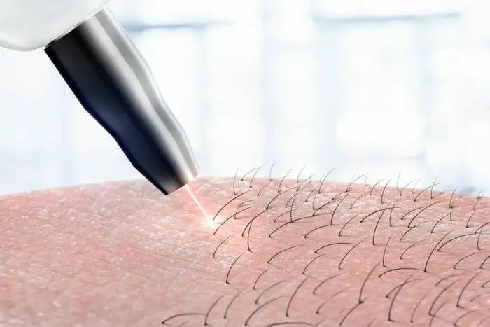 Is Laser Hair Removal Safe for Nigerian Skin?
