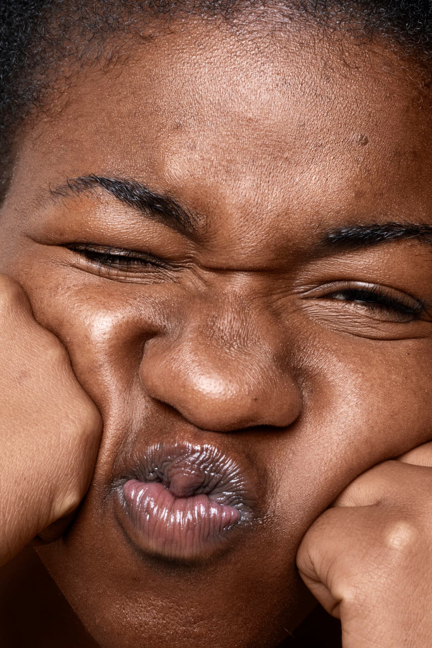 Understanding Acne on Dark Skin: A Guide by Your Ibadan Dermatologist