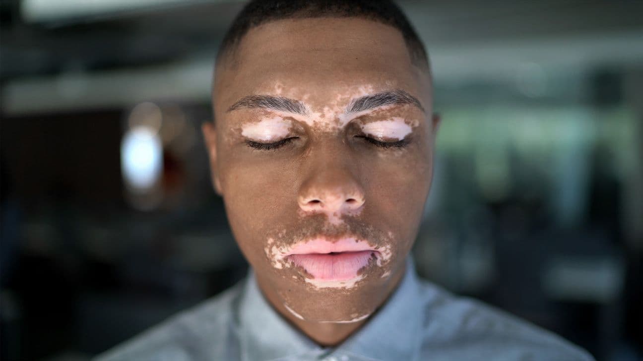 Treating Eczema in Ibadan's Humid Climate